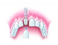 implants