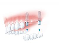 implants2