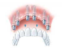 implants3