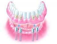 implants4